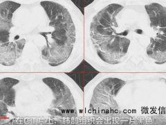 肺部“变白”会有哪些异常？ 不能耽误一切以CT检查结果为准
