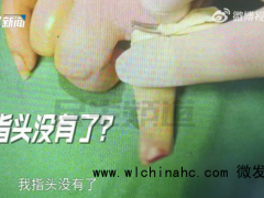 孕妇吃火锅拉了一下凳子手指被切断，当事人：怀孕做不了手术，指头彻底没了，店长：我们没什么责任