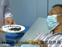 男子常年大吃大喝胆囊有上百颗结石 医生:管住嘴很重要