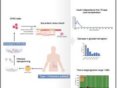 世界首例!我国学者利用干细胞成功治疗1型糖尿病 开辟医疗新纪元