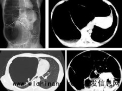 女子便秘20年手术掏出60cm长结肠 特发性巨结肠病例[推荐]