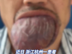 男子患病舌头疯长肿成紫红色沙包 患病20年[推荐]
