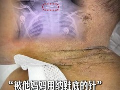 10月大男婴被母亲扎数百针 虐童事件引发社会关注[推荐]